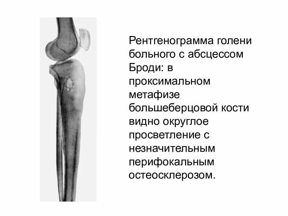 Проксимальный отдел большеберцовой кости фото Остеосклероз большеберцовой кости