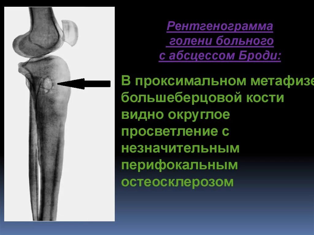 Проксимальный отдел большеберцовой кости фото Проксимальная кость: найдено 82 изображений