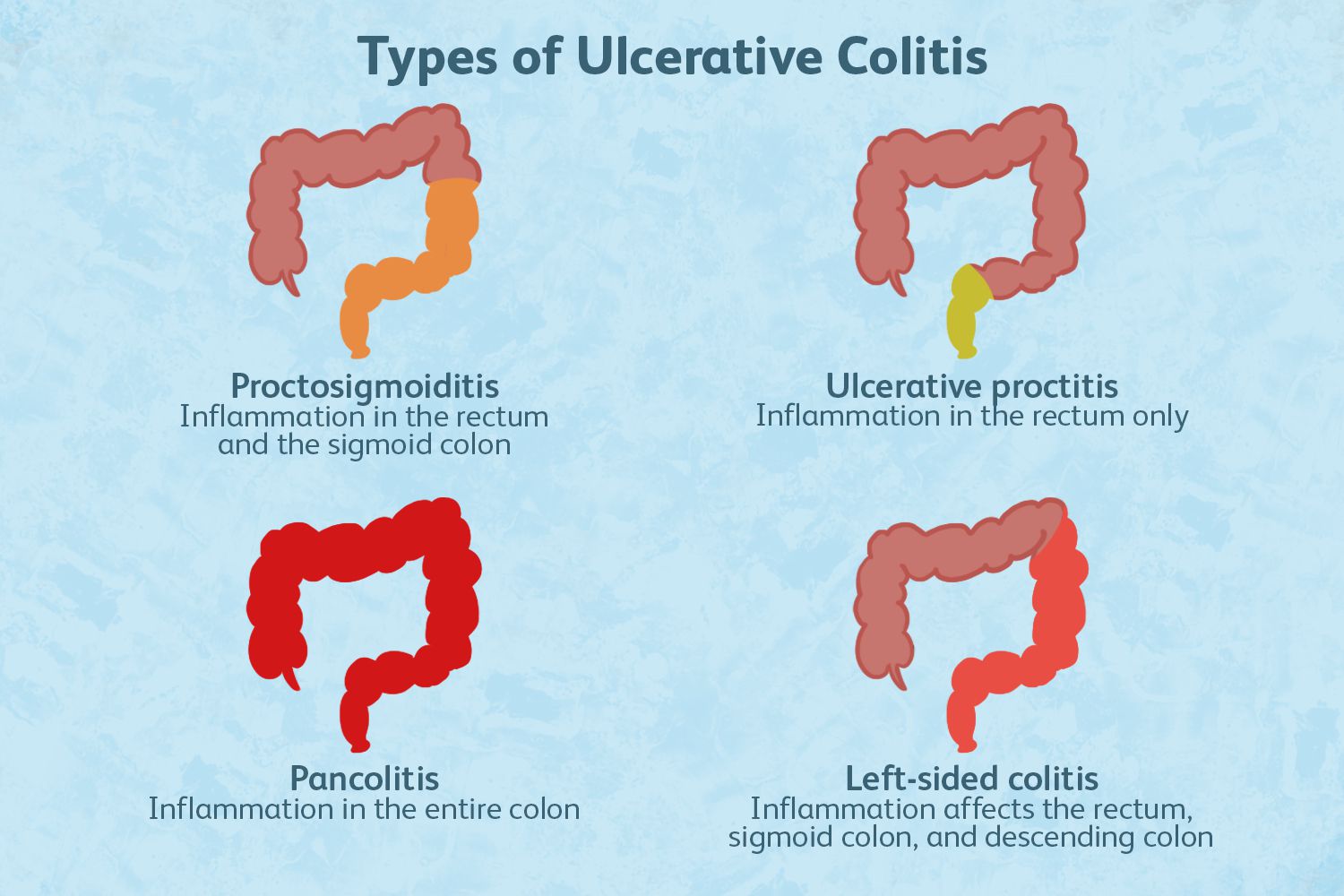 Проктит фото снаружи Types of Ulcerative Colitis (UC), ulcerative colitis - cvu.by