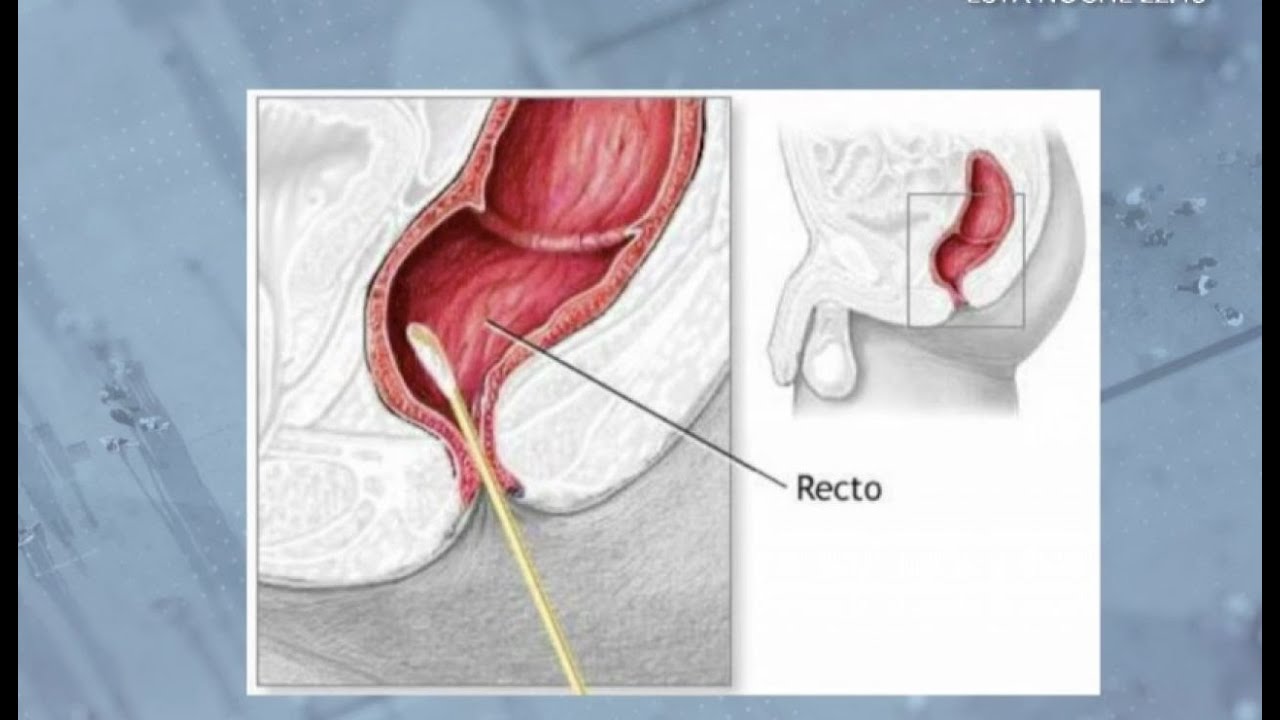 Проктит симптомы фото Test anales de covid-19. Opiniones de un pueblo. Emitido el día 10/02/2021. - Yo