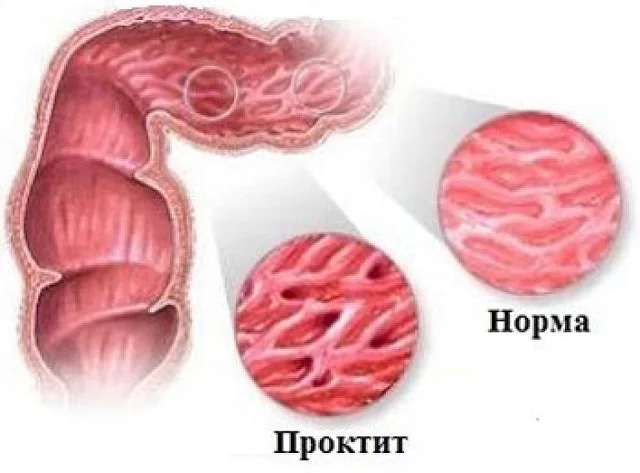 Проктит симптомы фото Проктит: причины, симптомы, лечение поэтапно