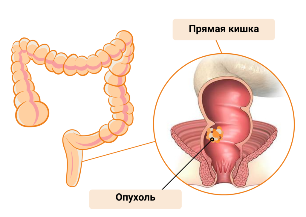 Проктит симптомы фото Рак прямой кишки - диагностика, лечение, запись к врачу "ОнкоМедикал"