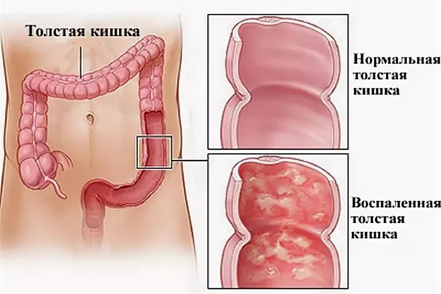 Проктит симптомы фото Цитомегаловирусный колит Университетская клиника