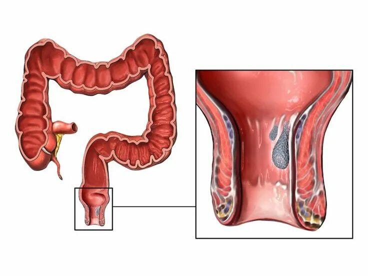 Проктит симптомы фото Pin on Hemorrhoid Grades