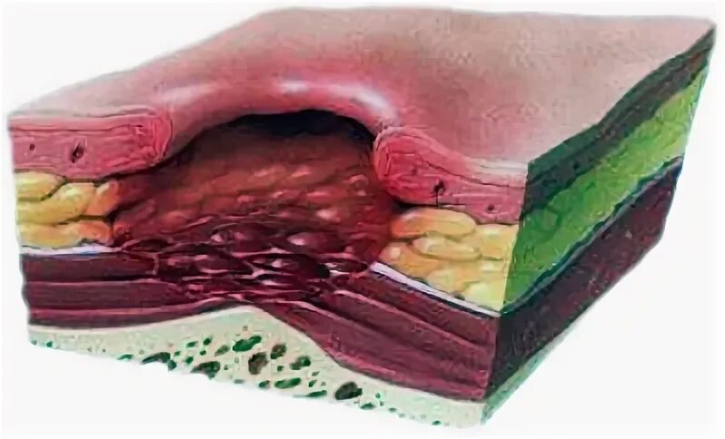 Пролежень фото на человеке 1 стадия Степени развития пролежней: Стадии пролежней