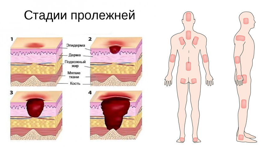 Пролежень фото на человеке 1 стадия Памятка для пациентов с пролежнями: Пациентам