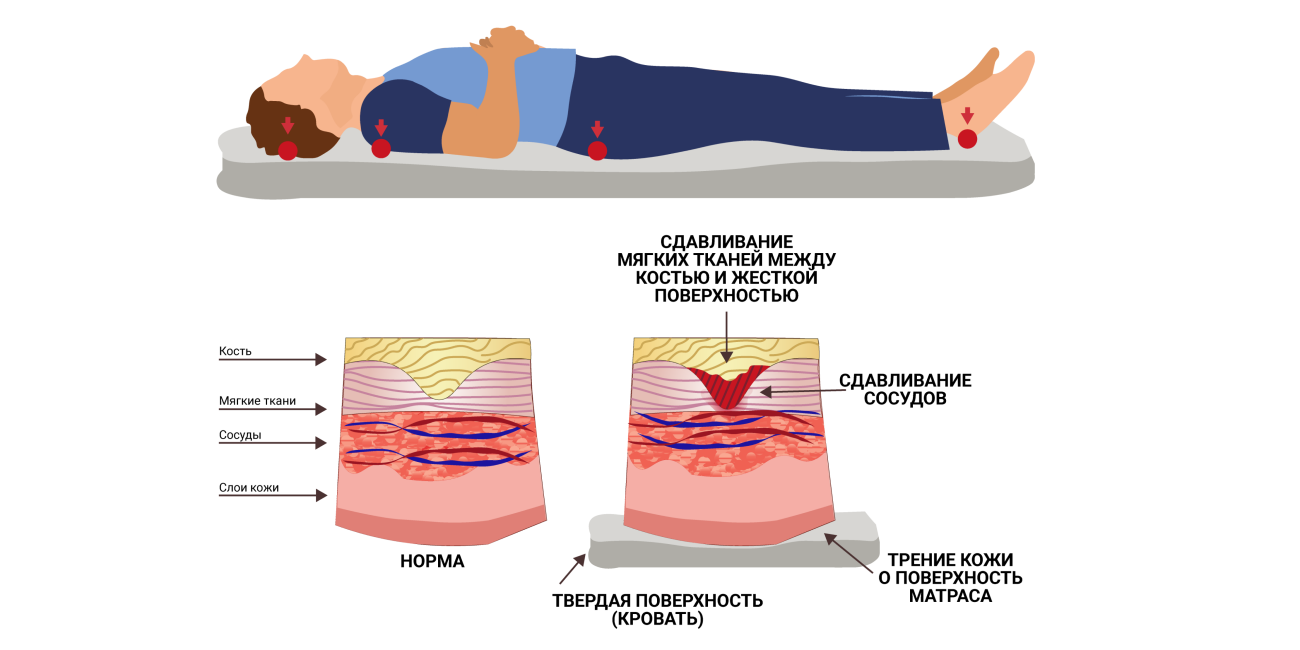 Пролежень фото на человеке 1 стадия Мази и кремы для обработки и лечения пролежней у лежачих больных