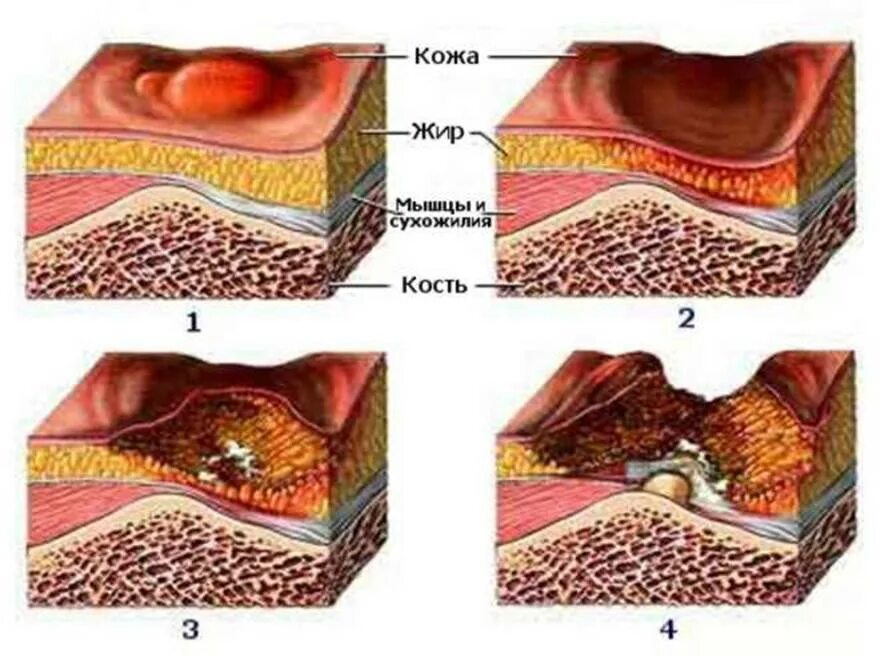 Пролежни 4 стадии фото Лучшие матрасы для лежачих больных: что нужно знать и как выбрать