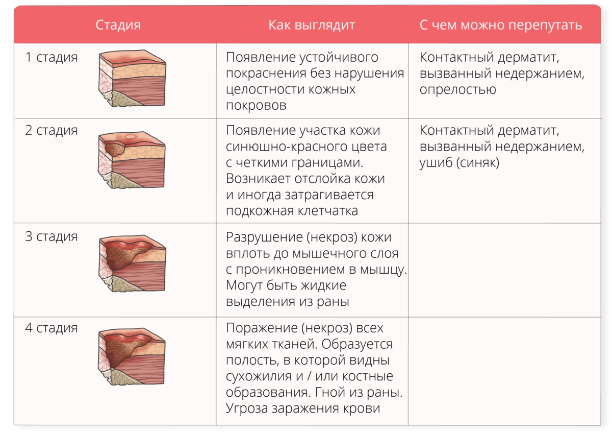 Пролежни 4 стадии фото Схема лечения пролежней 3 степени