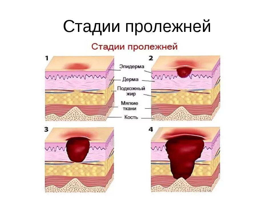 Пролежни 4 стадии фото В статье описаны методы лечения пролежней у лежачих больных, средства профилакти