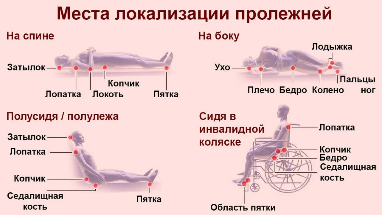 Пролежни 4 стадии фото Профилактика пролежней у лежачих больных ГБУСО "Александровский комплексный цент