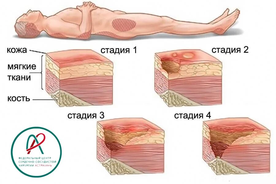 Пролежни 4 стадии фото Пролежни.