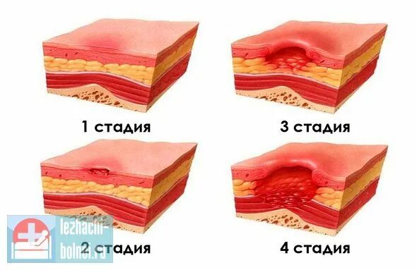 Пролежни 4 стадии фото на человеке Особенности лечения пролежней в начальной стадии