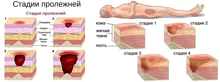 Пролежни 4 стадии фото на человеке Спреи и другие средства для лечения пролежней