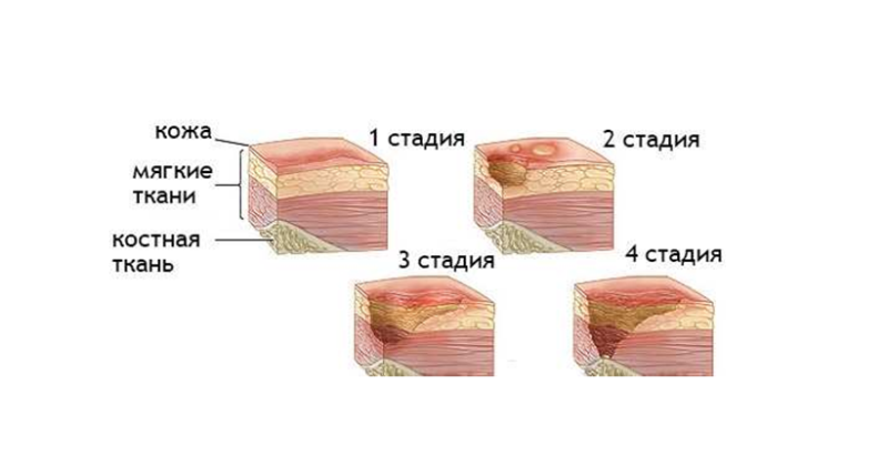 Пролежни 4 стадии лечение фото Трофическая язва - признаки, причины, симптомы, лечение и профилактика - iDoctor