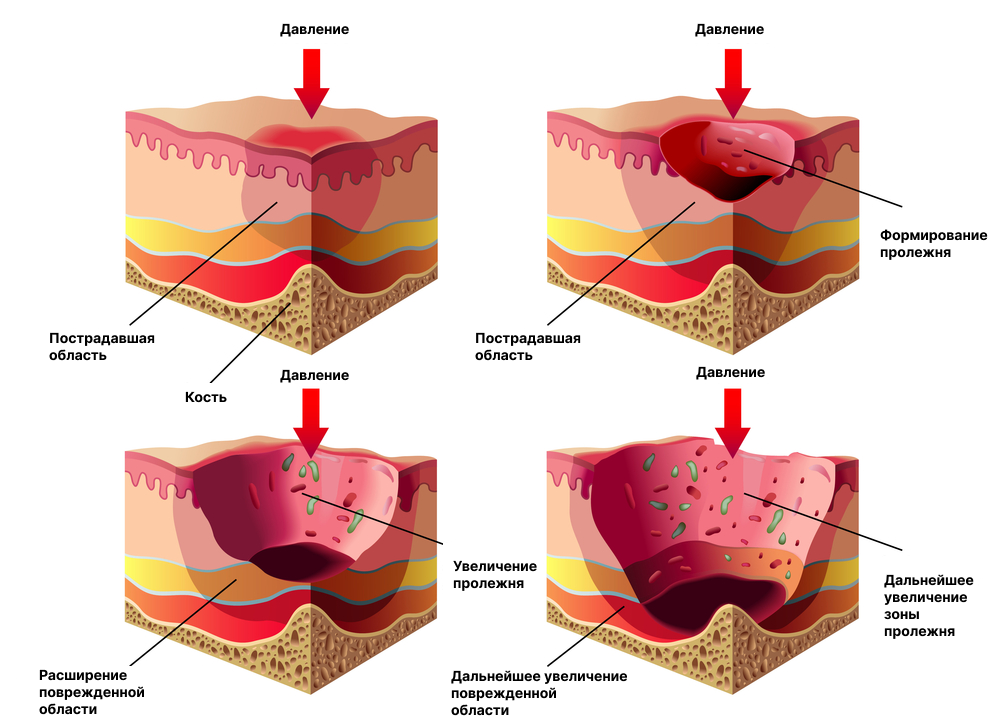 Пролежни 4 стадия реальные фото Пролежни у лежачих больных - уход и лечение в Москве