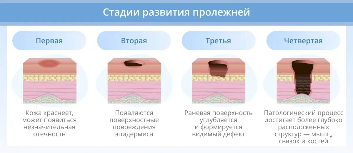 Пролежни четвертой стадии фото Профилактика пролежней у лежачих больных: что используют и как проводить?