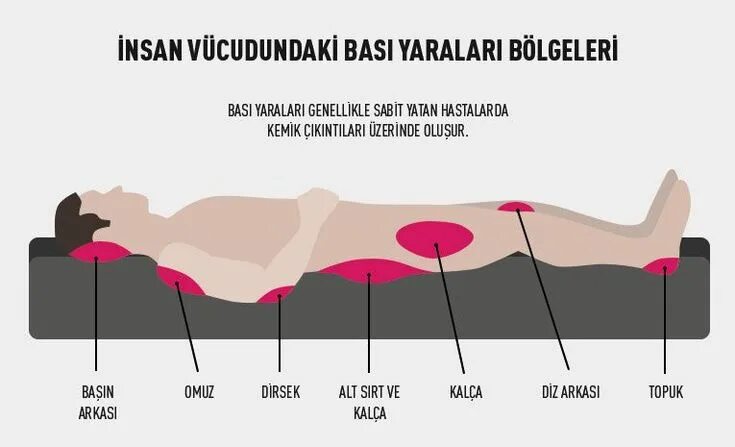 Пролежни до кости фото на человеке Yatak yaraları (bası yaraları) Resim, Insan vücudu