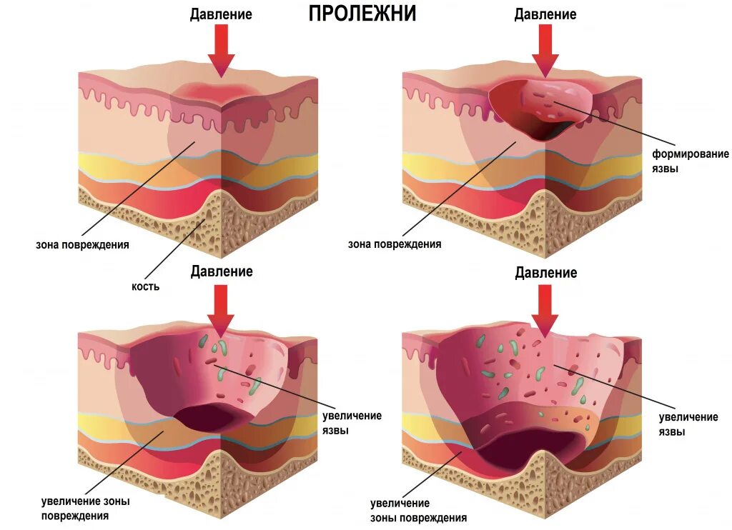 Пролежни.