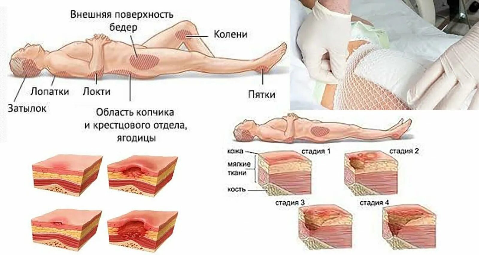 Пролежни фото как выглядят у человека лежачего Пролежень степени лечение - найдено 80 фото