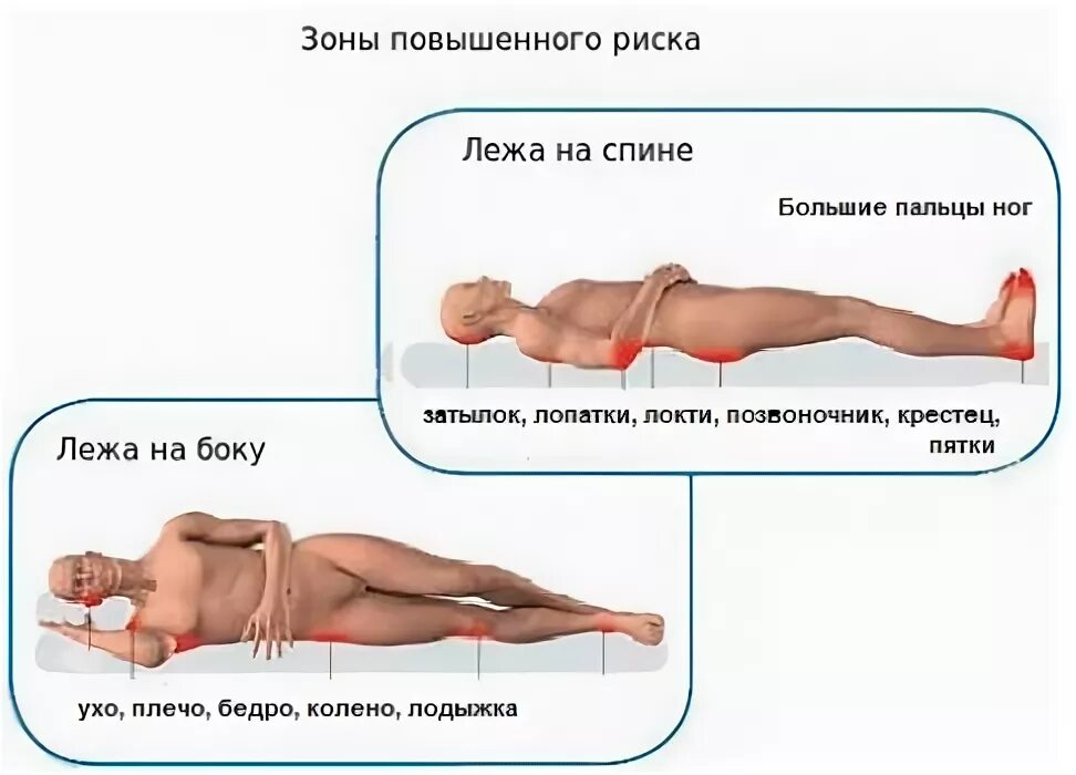 Пролежни. Профилактика и лечение Опека пансионаты