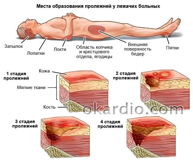 Пролежни фото как выглядят у человека лежачего Буклет Почему появляются пролежни - пролежни - Стадии пролежней i стадия