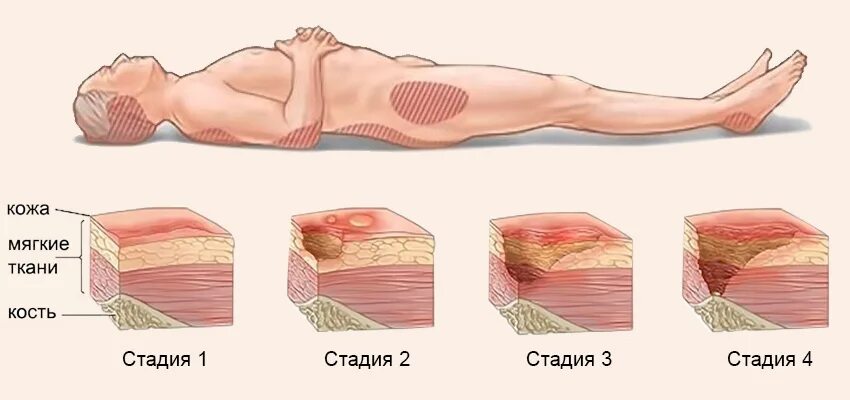 Пролежни фото начальная стадия Пролежни