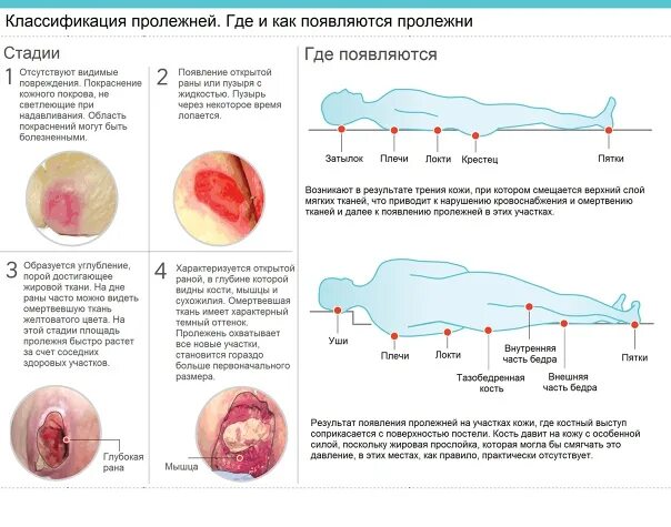 Пролежни фото начальная стадия Пролежни - Фотография 8 из 16 ВКонтакте