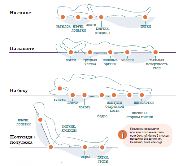Пролежни фото по стадиям Современные методы профилактики пролежней