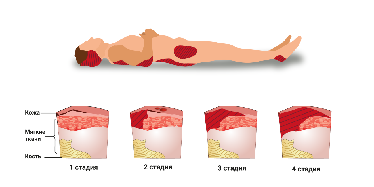 Пролежни фото по стадиям на человеке Пролежни: стадии, лечение, профилактика у лежачих больных