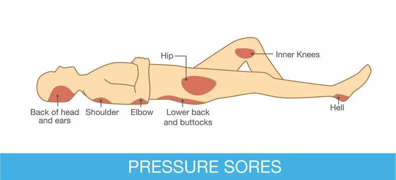 Пролежни на ухе фото Sore Sleeping Shoulder Изображения: просматривайте стоковые фотографии, векторны