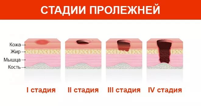 Пролежни: стадии, лечение, профилактика у лежачих больных