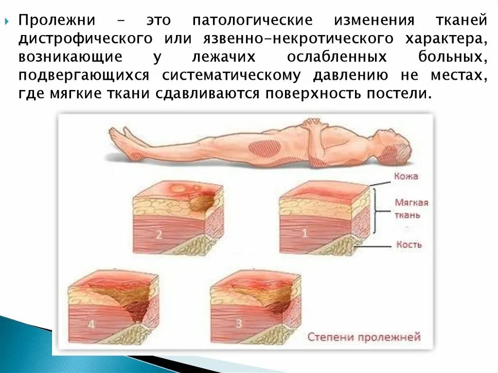 Чем лечить пролежни у пожилого лежачего человека и как правильно проводить профи