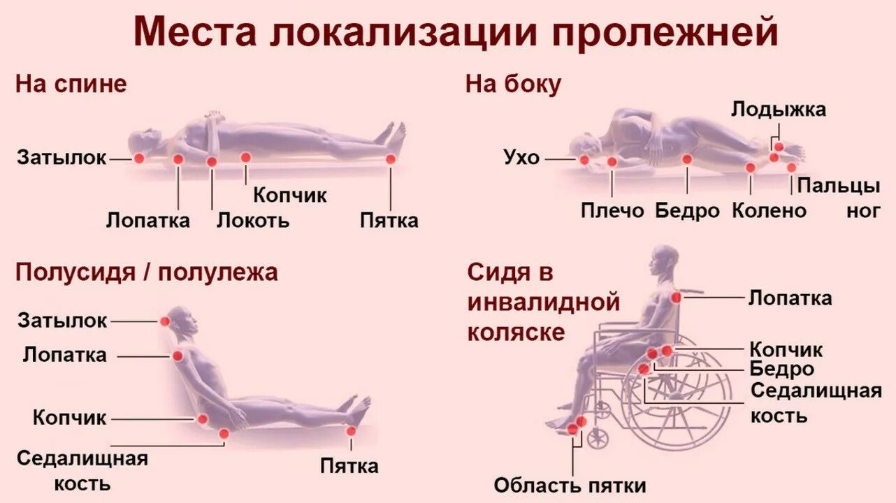 Пролежни у лежачих больных фото как выглядят Школа ухода. Уход за лежачими Комплексный центр социального обслуживания населен