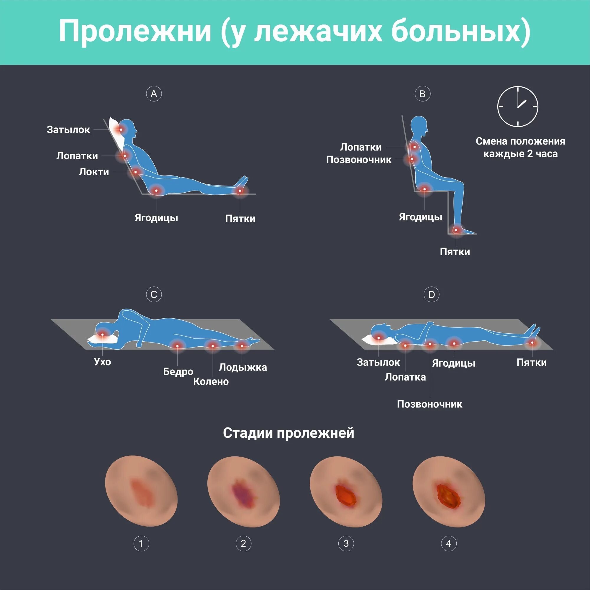 Пролежни у лежачих больных фото как выглядят Отит - лечение у взрослых дома, советы при наружном отите