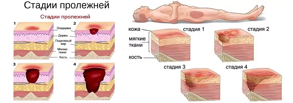 Пролежни у лежачих стадии фото Глубокие раны 2021