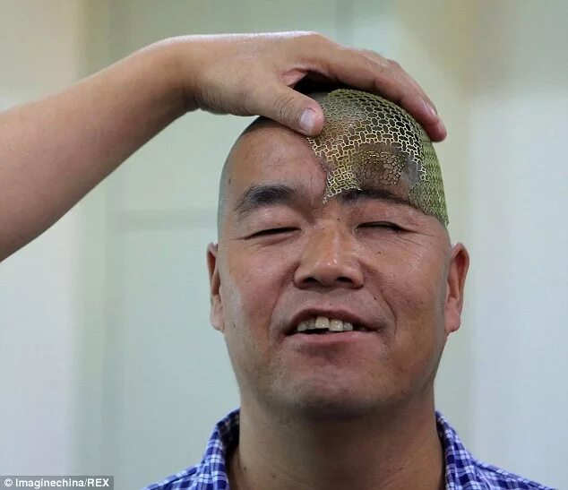 Проломленный череп фото Farmer who lost half his skull in fall has it rebuilt using 3D printed titanium 