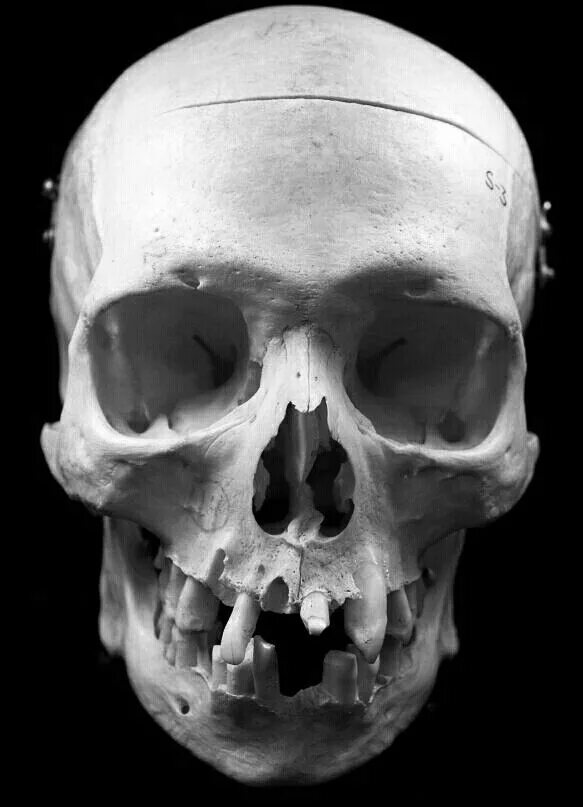 Проломленный череп фото Real Skull Skull reference, Human skull photography, Skull anatomy