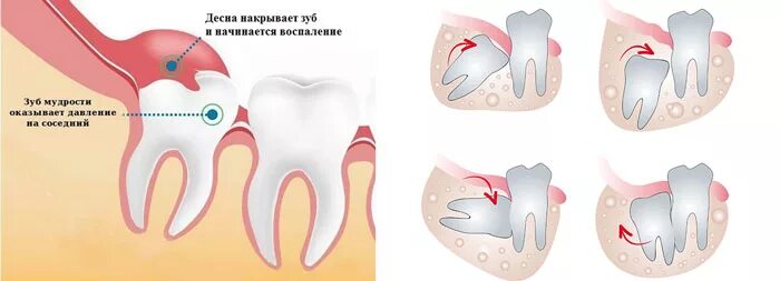 Прорезывание зуба мудрости фото Больно есть зубами: найдено 77 изображений