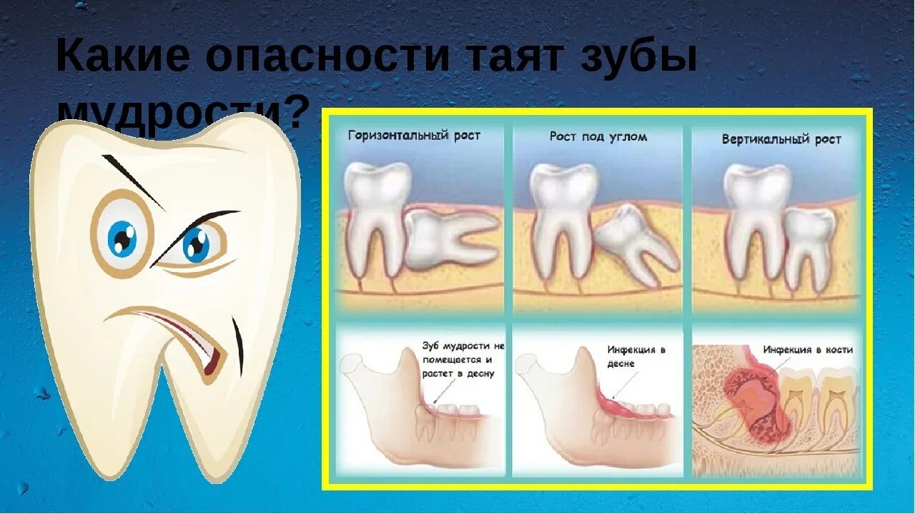 Прорезывание зуба мудрости фото Чем отличается зуб мудрости