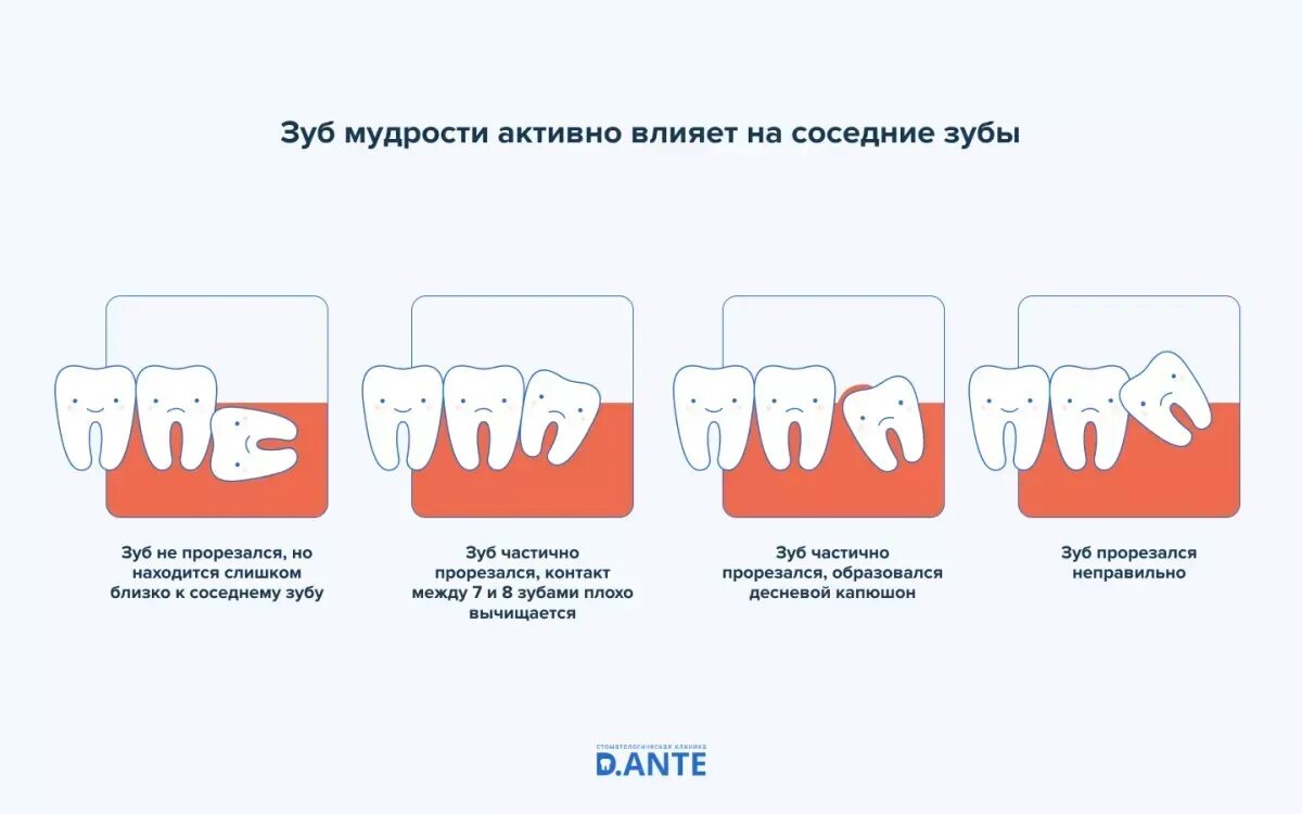 Прорезывание зуба мудрости фото Удаление зуба мудрости схема