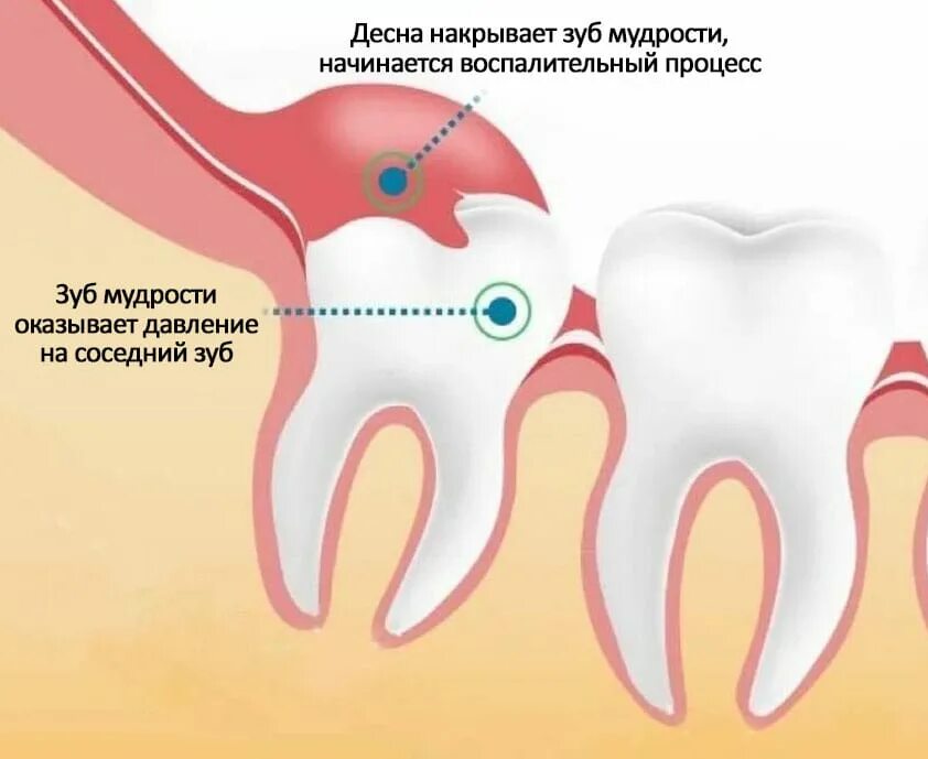 Прорезывание зуба мудрости фото Воспалилась десна около зуба мудрости - Стоматология в Томске