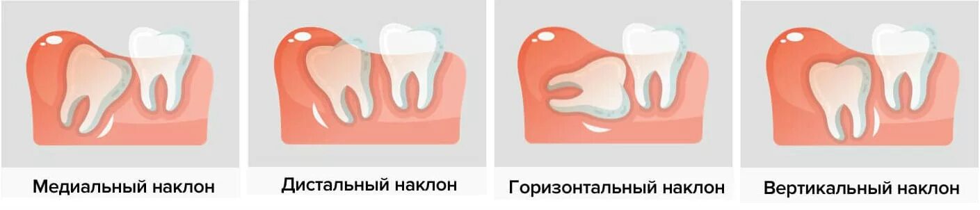 Прорезывание зубов мудрости фото десны Удаление зубов - крайняя мера Блог стоматологии "Медицина Вологды"