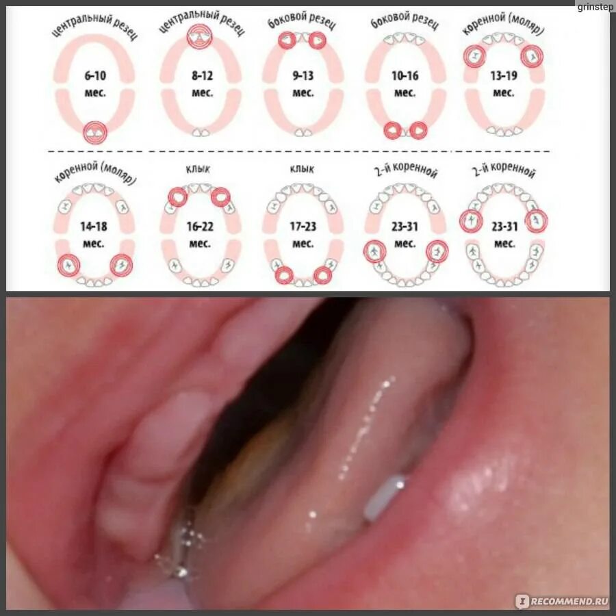Прорезывание зубов схема фото Сколько дней лезет первый зуб у грудничка: длительность роста и прорезывания