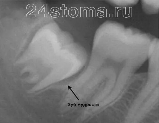 Прорезывающийся зуб мудрости фото Зуб мудрости растет и болит десна - что делать, быстрая помощь