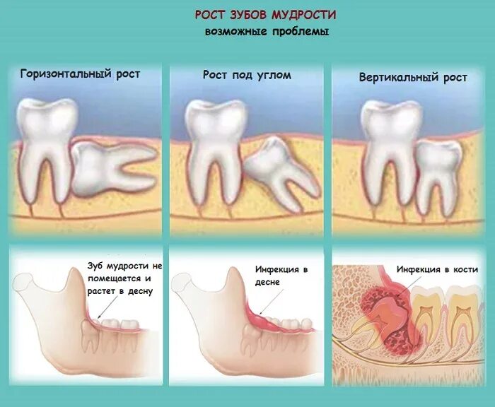 Прорезывающийся зуб мудрости фото Лечение зуба мудрости в Москве Клиника Медлайн сервис