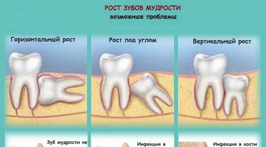 Прорезывающийся зуб мудрости фото Зуб мудрости на схеме зубов