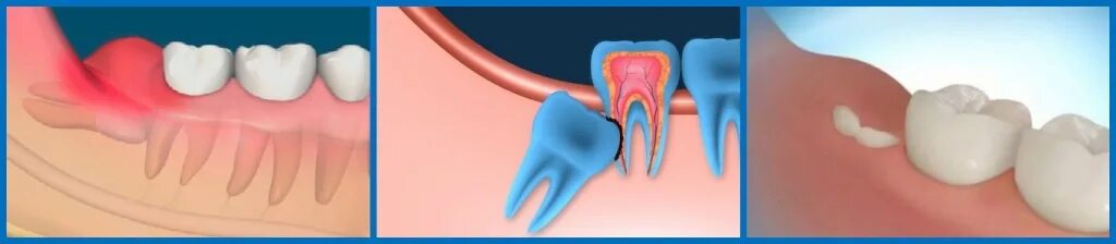 Прорезывающийся зуб мудрости фото Для чего нужны зубы мудрости, какая польза от зубов мудрости?