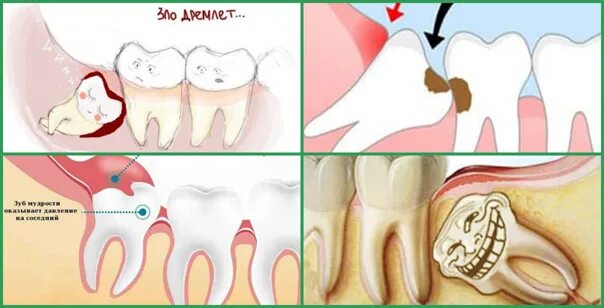 Прорезывающийся зуб мудрости фото Зуб отдает в другой зуб: найдено 90 изображений