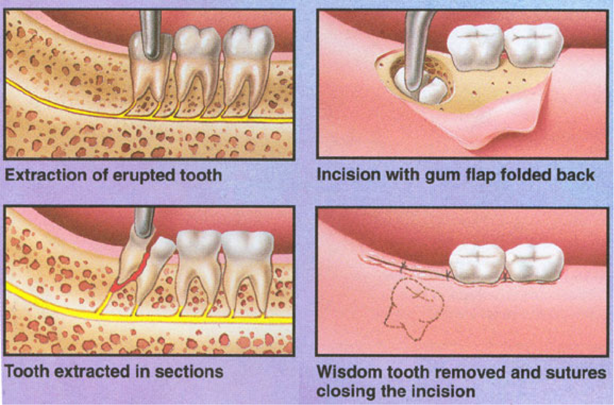 Прорезывающийся зуб мудрости фото Через сколько перестанет болеть удаленный зуб - найдено 56 картинок